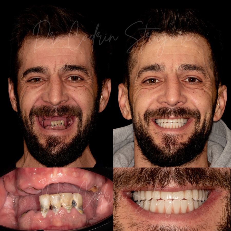 Caz reabilitare orală pe implanturi — înainte și după